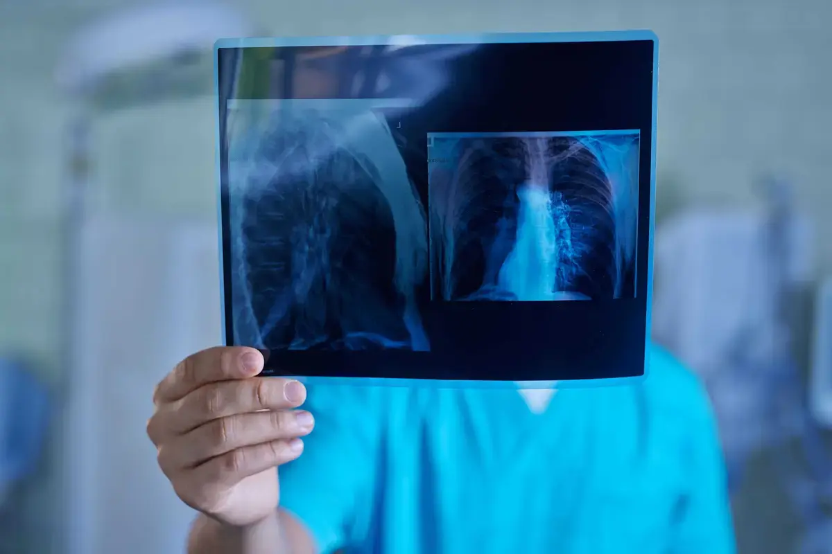 Cancerul pulmonar: depistarea timpurie salvează vieți